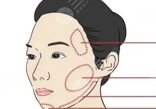 輪廓固定提升多少錢做一次好？