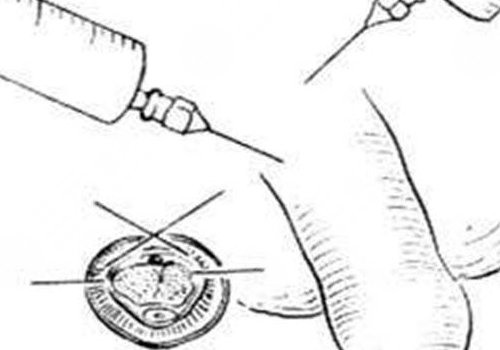 玻尿酸男性增大注射要多少錢(qián)？