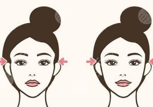 假體填充太陽凹大概多少錢？