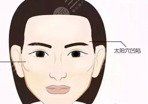 玻尿酸填充太陽凹大概多少錢？