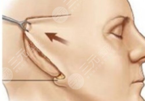 面部提升術(shù)的危害有什么？