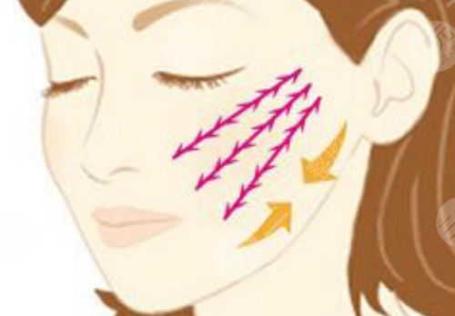 筋膜輪廓固定是什么意思