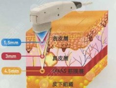 35歲面部提升好的方法有哪些？4種醫(yī)美項目，除皺抗衰可選！