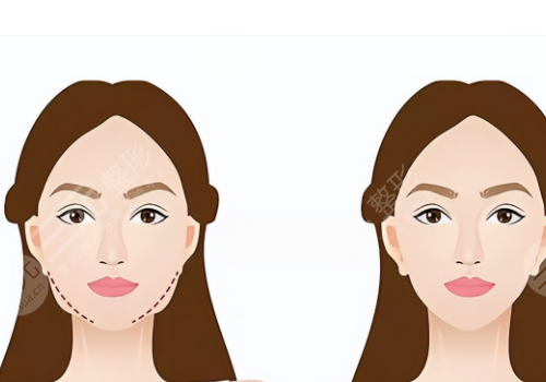 下頜提升針幾天有效果？