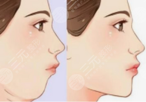 下頜提升針幾天有效果
