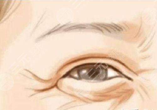 面部筋膜提升術能保持多久