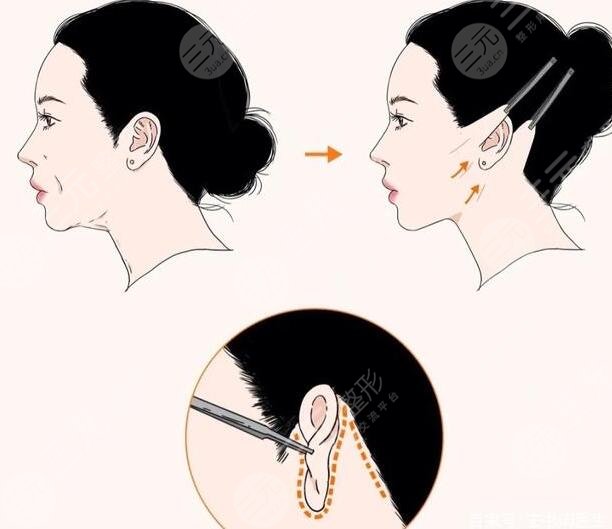 小拉皮手術(shù)全過(guò)程分享