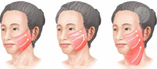 小拉皮手術(shù)適合哪種人群手術(shù)?