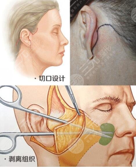 做完小拉皮手術(shù)后需要怎樣護(hù)理?