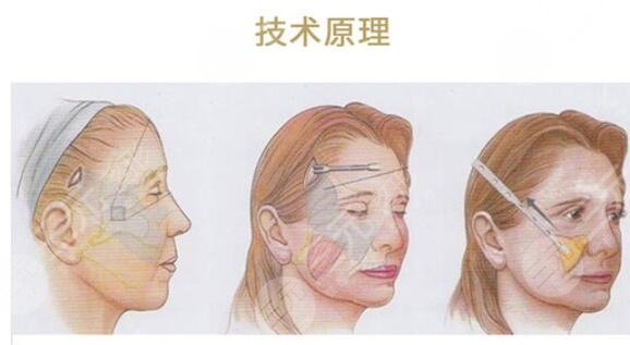 做完小拉皮手術(shù)后需要怎樣護(hù)理?