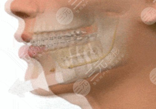 臉部骨骼變形能矯正嗎？