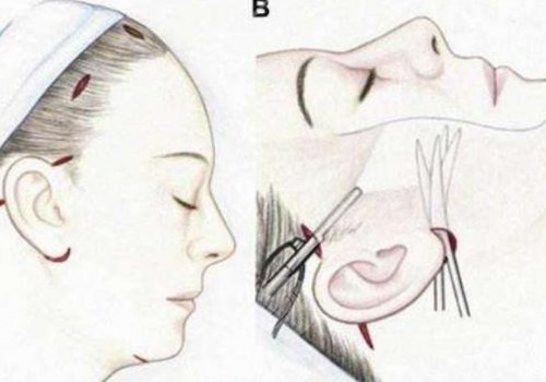 筋膜懸吊面部提升術(shù)恢復(fù)期多久？