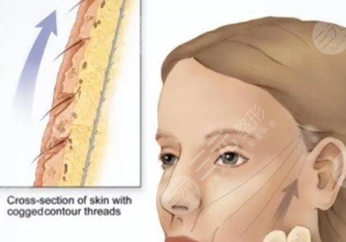 筋膜懸吊面部提升術(shù)恢復(fù)期多久？