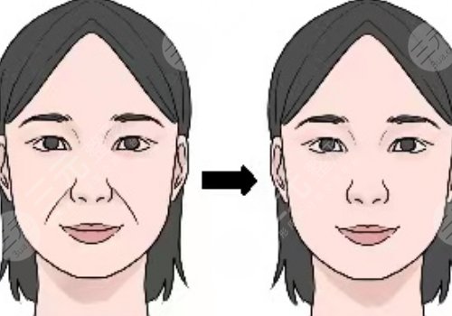 筋膜懸吊面部提升術(shù)恢復(fù)期多久？