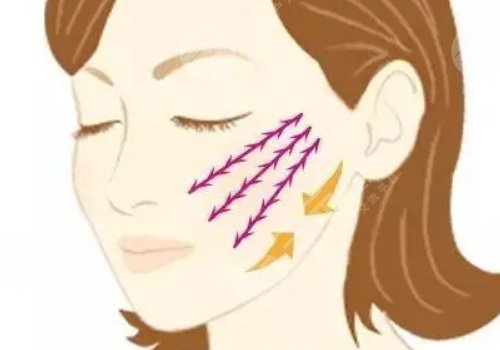 筋膜懸吊面部提升術(shù)恢復(fù)期多久？