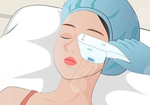 超聲炮三天后臉變方