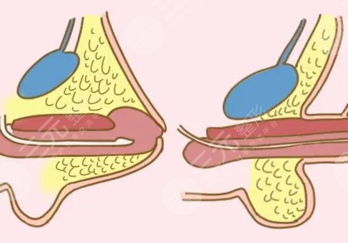 男人增長(zhǎng)手術(shù)大概需要多少錢？