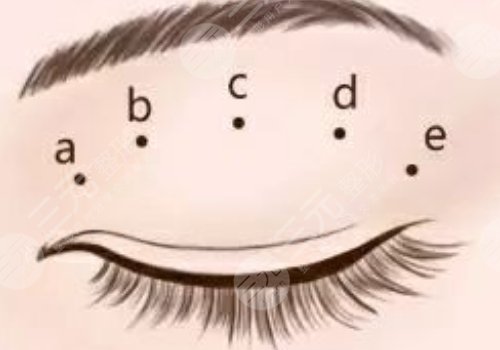 怎么做雙眼皮自然？
