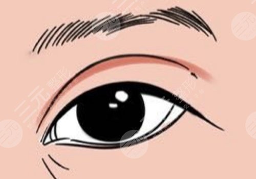 怎么做雙眼皮自然？