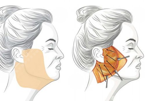 什么是筋膜懸吊面部提升術(shù)？