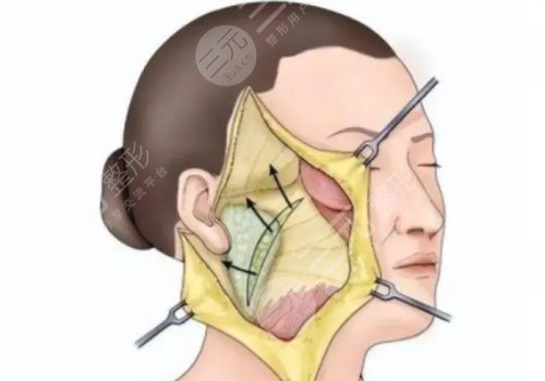 什么是筋膜懸吊面部提升術(shù)？
