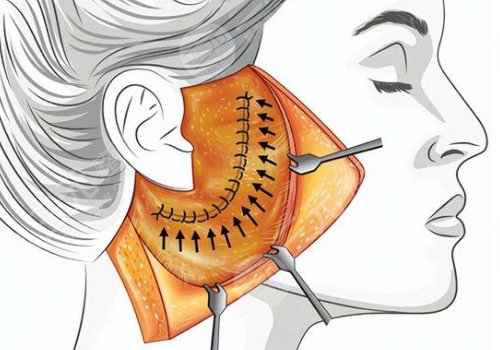 什么是筋膜懸吊面部提升術(shù)？