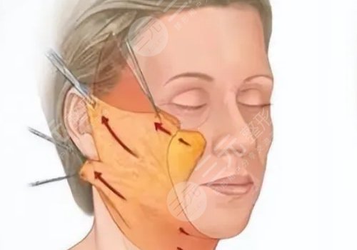 筋膜懸吊提升術(shù)能保持多久