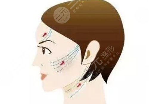 皺紋去除的好辦法是什么？