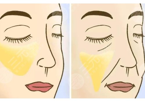 皺紋去除的好辦法是什么？