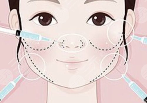 瑞藍玻尿酸打在哪個部位？