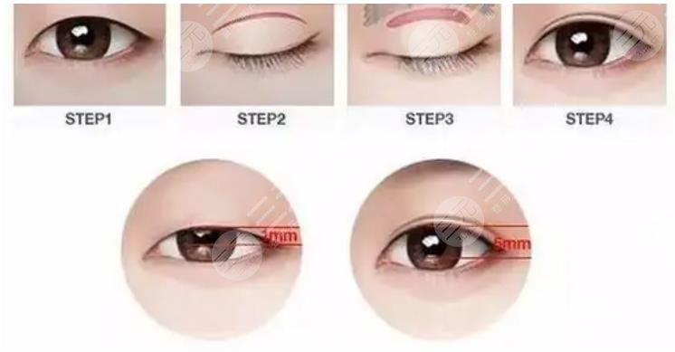 澄海南方醫(yī)院割雙眼皮多少錢(qián)