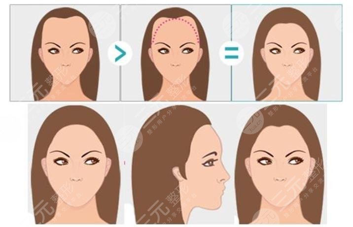 上海中山醫(yī)院植發(fā)多少錢