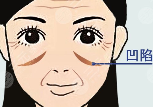 印第安紋怎么去除？