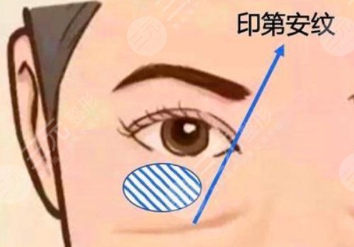 印第安紋和淚溝的區(qū)別是什么？