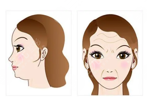 額頭填充玻尿酸能保持多久