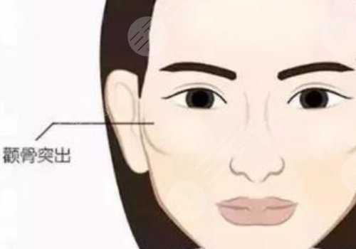 顴骨高怎么改良臉型？