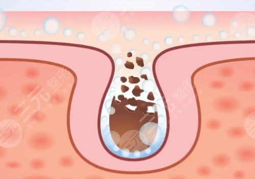 面頰毛孔粗大怎么辦？