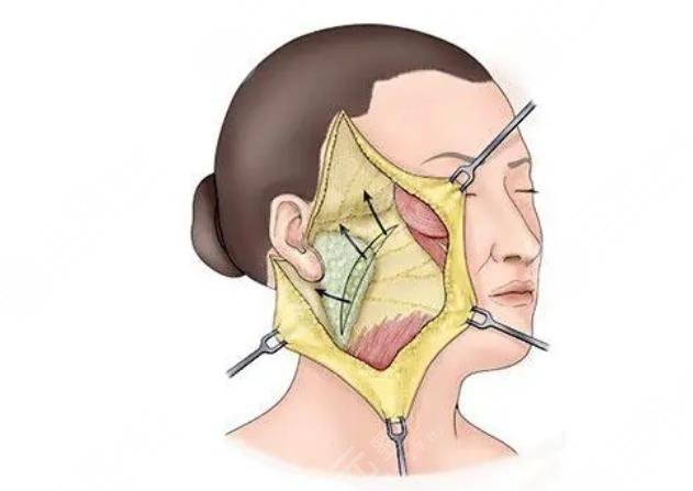 黃廣香醫(yī)生拉皮手術案例