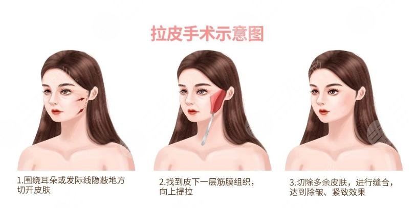 魏廣運醫(yī)生拉皮手術案例