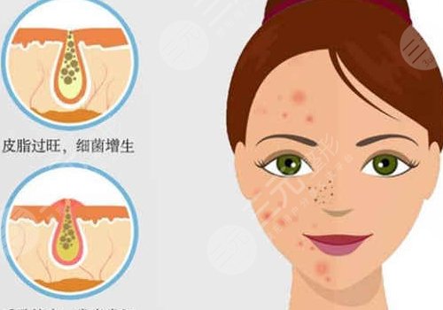 t區(qū)反復(fù)長(zhǎng)痘痘的原因是什么？