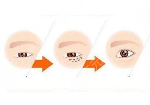 臥蠶填充用什么填好？