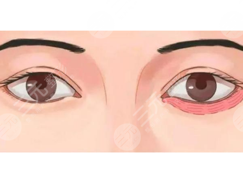 臥蠶填充用什么填好？