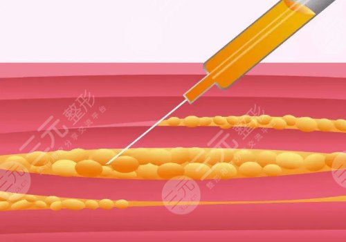 臥蠶填充需要多少錢