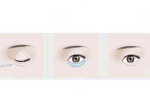 臥蠶填充需要多少錢