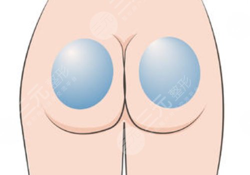 假體豐臀需要多少錢？