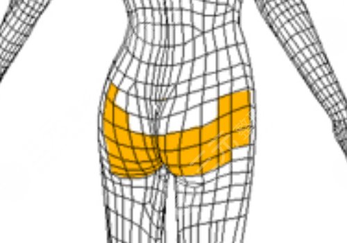 假體豐臀需要多少錢？