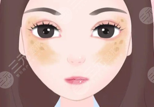 臉頰兩側(cè)長斑是什么原因？