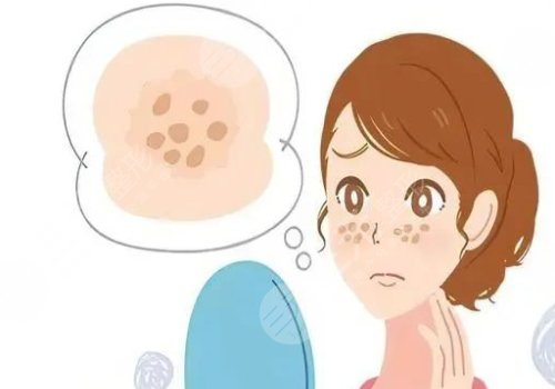 臉頰兩側(cè)長斑是什么原因？