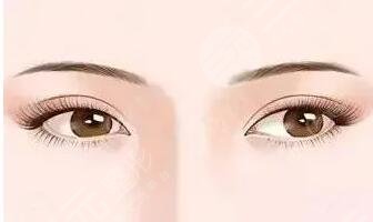 中國醫(yī)學科學院整形科雙眼皮案例