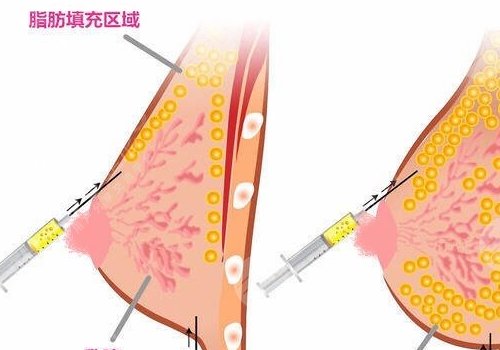 胸型不好看可以調(diào)整嗎？
